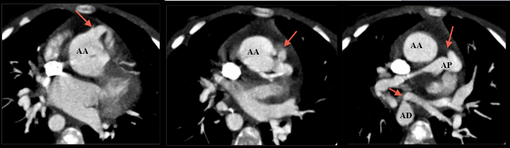 Exemple de collatérales coronaro-pulmonaires en scanner. Noter également une MAPCA au niveau de l'AD sur la troisième image.