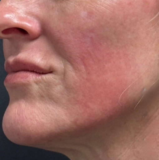 Vor Behandlung mit zwei Ampullen Sculptra