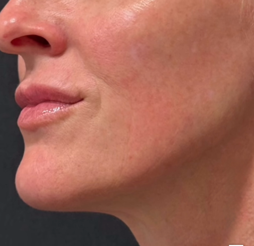 Nach Behandlung mit zwei Ampullen Sculptra