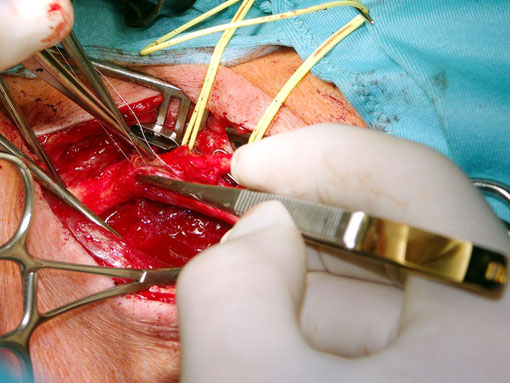 Gefäßchirurgie: Anastomosennaht Arteria carotis interna (Hirnschlagader) Prim. Dr. Thomas Mayrhofer, Facharzt für Chirurgie und Gefäßchirurgie