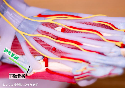 裂離骨折というのはこういうこと