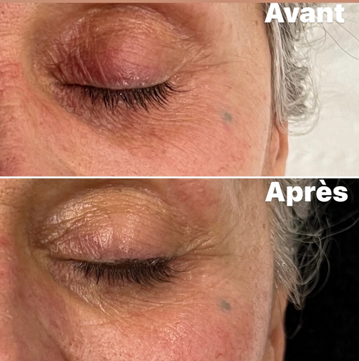 Avant/Après 1 séance de microneedling drainage des cernes: cernes atténuées, rides estompées et teint plus frais lumineux. Effet glow