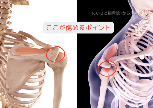 棘上筋腱の損傷しやすい部分