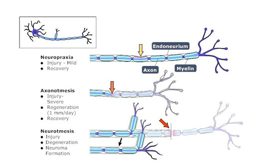 types of neural damage: neuropraxia, axonotmesis, neurotmesis