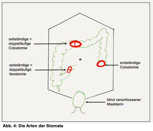 Knubbel scheide Knubbel an