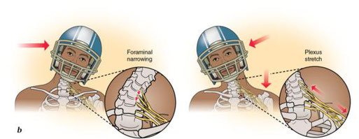 brachial plexus lesion mechanism