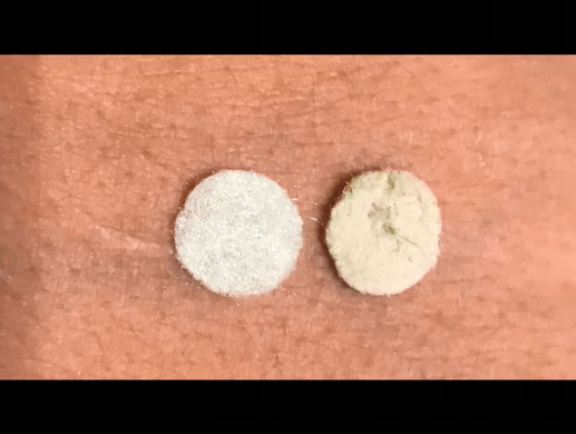 Hautabtragung Vor und nach dem Filterwechsel