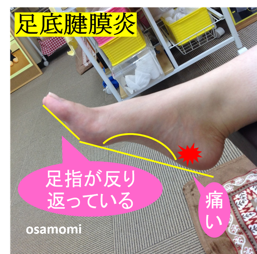 オサモミ整体院 足底腱膜炎 浮き指