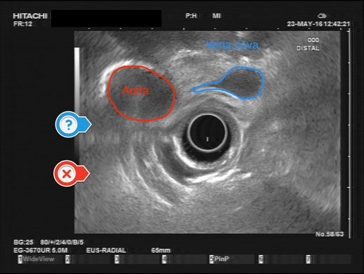 Endosonographie Leitstruktur Aorta Vena cava, cross sectional view, endoscope in the duodenal position