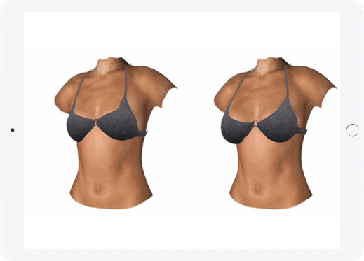 Brustvergrösserung in 3D