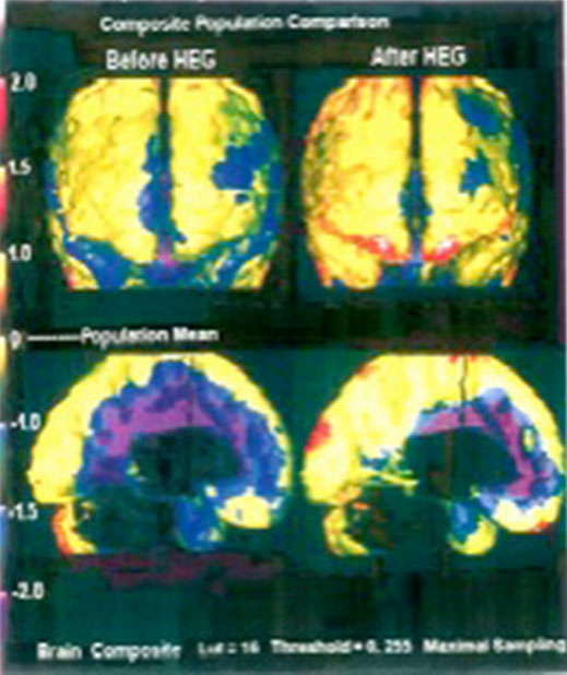 SPECT-Bilder der cerebralen Durchblutung einer 67-jährigen Patientin mit Gedächtnisverlust, Angst und Depressionen, vor und nach 23 HEG-Behandlungen: deutliche Verbesserung in den Frontal- und Temporallappen (weniger blaue, dafür mehr rote Bereiche)