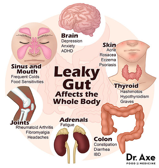 Radiant Reality Blog | Leaky Gut Symptoms | Dr. Axe - http://draxe.com/4-steps-to-heal-leaky-gut-and-autoimmune-disease/