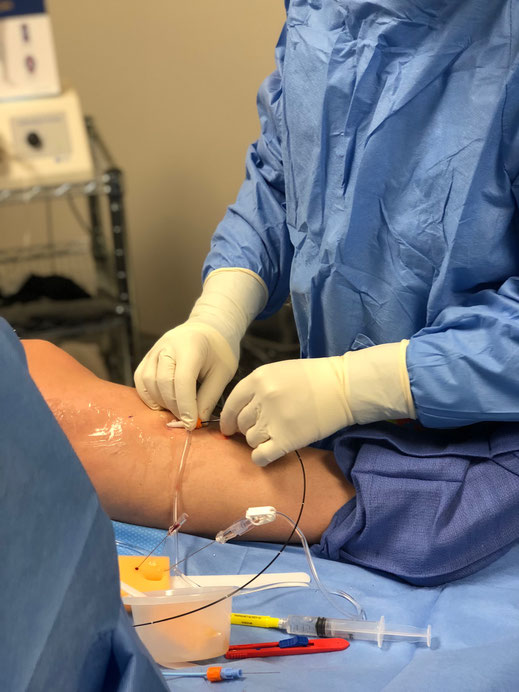 Dr. Paul Feldman of Truffles Vein Specialists performs radiofrequency ablation of the left great saphenous vein. He has performed the Venefit procedure thousands of times. 