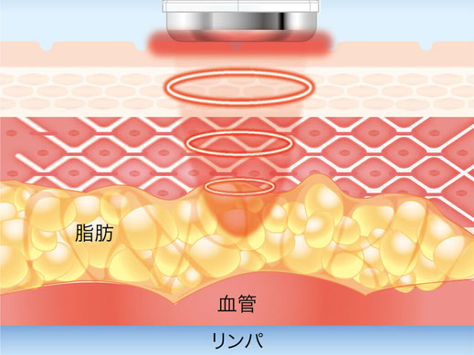 キャビテーション　福岡　クラシカ