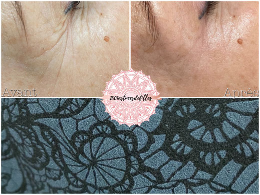 article blog masque dentelle noire cure la vie a vendome masque en tissu anti taches eclaircissant apaisant quand la haute couture s’invite sur votre peau tel un voile de dentelle institut de beaute lannemezan soins visage anti age anti rides avant apres