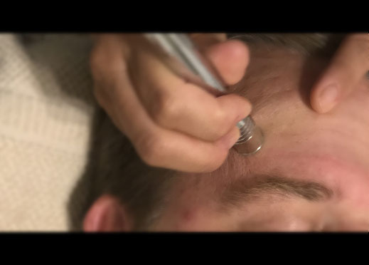 Diamant-Microdermabrasion