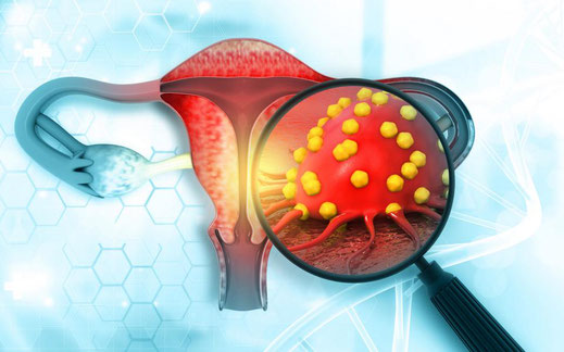 Gebärmutterkörperkrebs Gebärmutterkrebs Endometriumkarzinom 