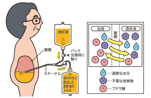 腹膜透析のしくみ