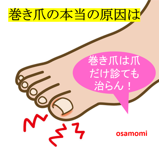オサモミ整体院 巻き爪の本当の原因