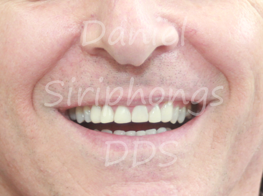 composite veneers after whitening