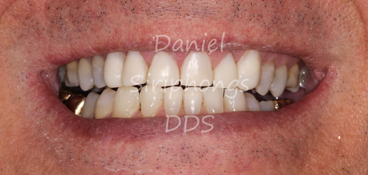 composite veneeer - after