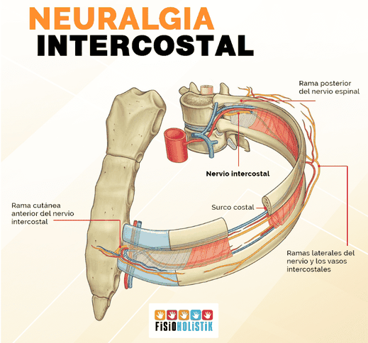 Neuralgia o neuritis intercostal