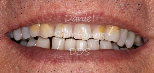 composite veneer before picture