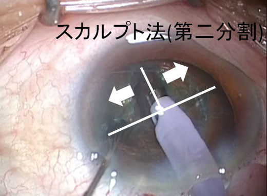 尼崎　眼科　緑内障　日帰り白内障手術　分割法　スカルプト法