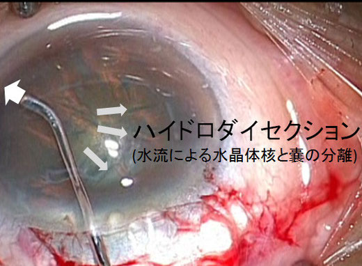 みやわき眼科 当院の白内障手術 - 尼崎市 緑内障 日帰り白内障手術 みやわき眼科 当院の白内障手術 - 尼崎市 緑内障 日帰り白内障手術