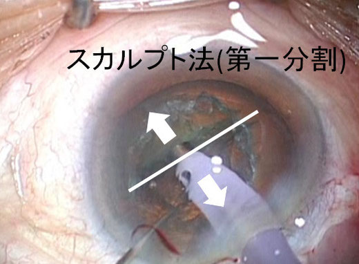 尼崎　眼科　緑内障　日帰り白内障手術　分割法　スカルプト法