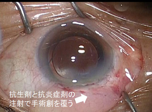 みやわき眼科 当院の白内障手術 - 尼崎市 緑内障 日帰り白内障手術 みやわき眼科 当院の白内障手術 - 尼崎市 緑内障 日帰り白内障手術