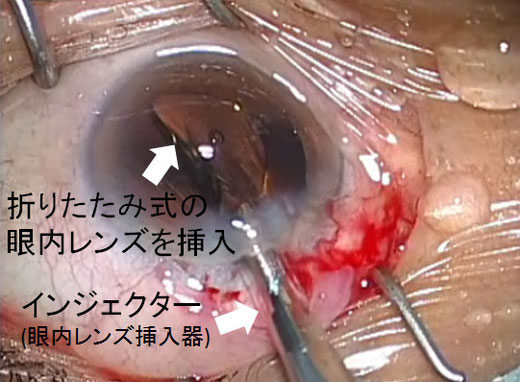 みやわき眼科 当院の白内障手術 - 尼崎市 緑内障 日帰り白内障手術 みやわき眼科 当院の白内障手術 - 尼崎市 緑内障 日帰り白内障手術