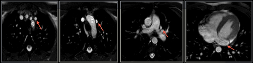 IRM coupes axiales: veine cave supérieure gauche, absence de TVI, dilatation du sinus coronaire
