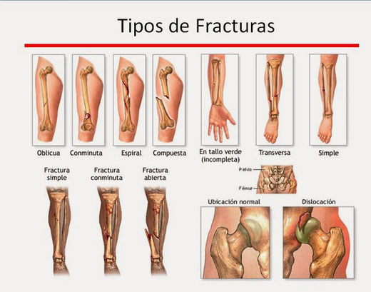 Tipos de fracturas.