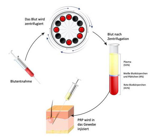 Autologous blood therapy for pilonidal cyst/sinus pilonidalis