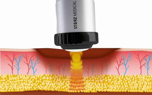 Scheme of shockwave therapy