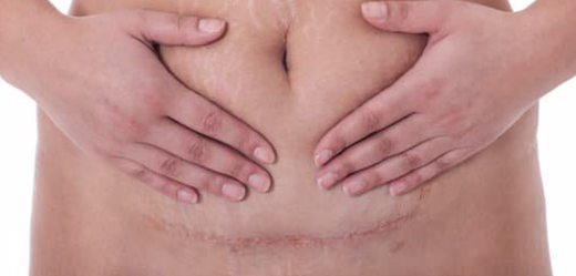 Douleur de cicatrice de césarienne