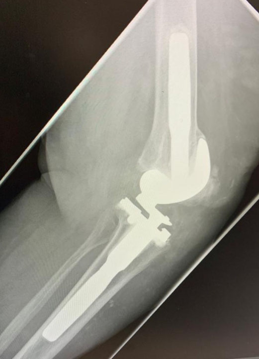 Postoperative Röntgenaufnahme gekoppelte Kniegelenksprothese 