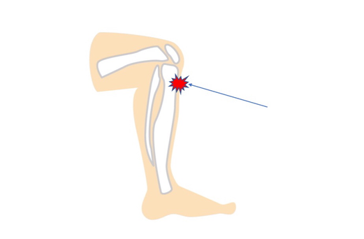 オスグッドシュラッター病には、ひざの下にある骨の出っ張りにつく大腿四頭筋が関係します。