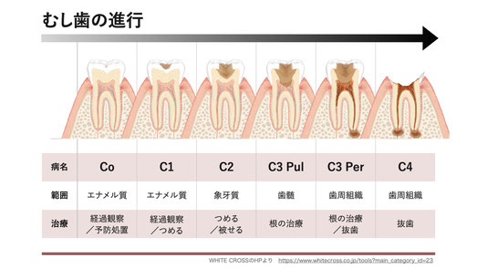 虫歯の痛み進行治療