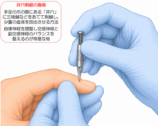 井穴刺絡イメージ