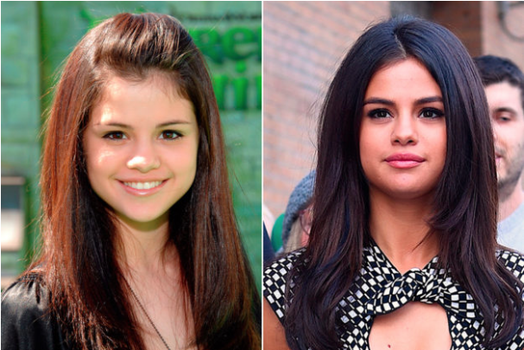 famosas aumento de labios antes despues