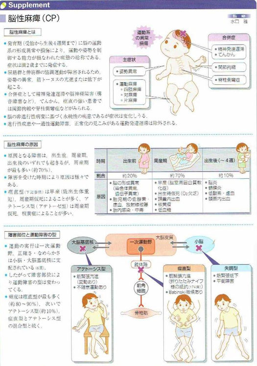 脳性麻痺とは運動や姿勢を制御する能力が損なわれた病態の総称とのことです。