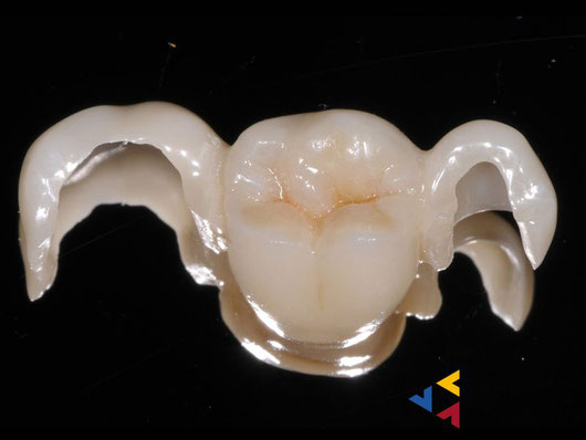 Im ersten Bild zeigen wir Ihnen eine individuell hergestellt Klebebrücke die einen verloren gegangenen Zahn mit einem Minimal Invasiven Verfahren ersetzt. 