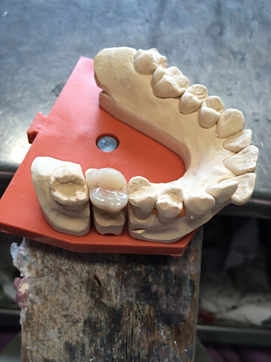 Im zweiten Bild zeigen wir Ihnen eine individuell hergestellte Glaskeramik Krone an Zahn 26 im Oberkiefer.   