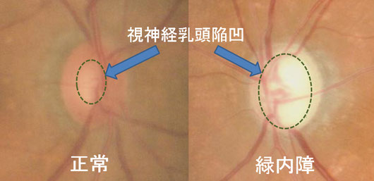 尼崎　眼科　緑内障　日帰り白内障手術　視神経乳頭