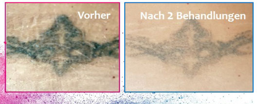 Before (left picture) and after two treatments with Pigmentkiller. 