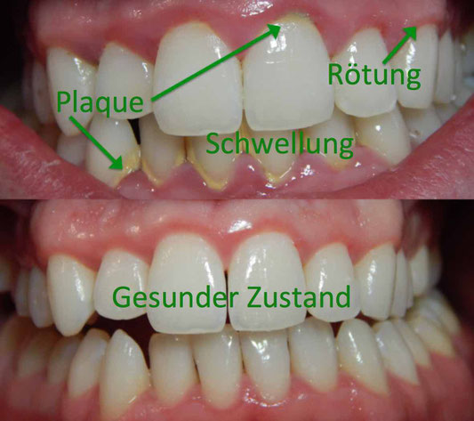Gingivitis