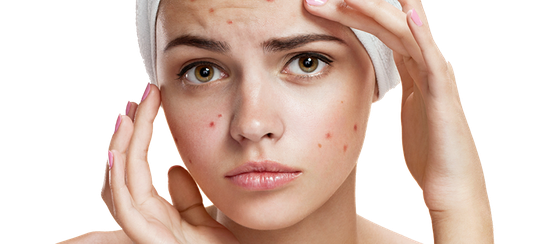 Akne – Folge von Hormonüberproduktion Als eine der Hauptursachen für Akne wird immer wieder eine Überproduktion von Androgenen ins Feld geführt.