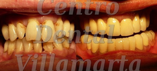 rehabilitación periodontal con attaches